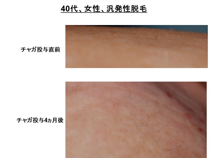 円形脱毛症　病院